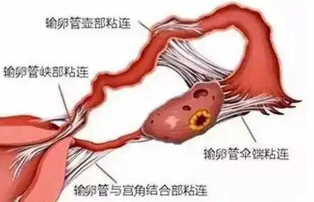 输卵管粘怎样治最好