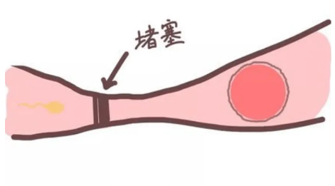 输卵管堵塞应该怎么办