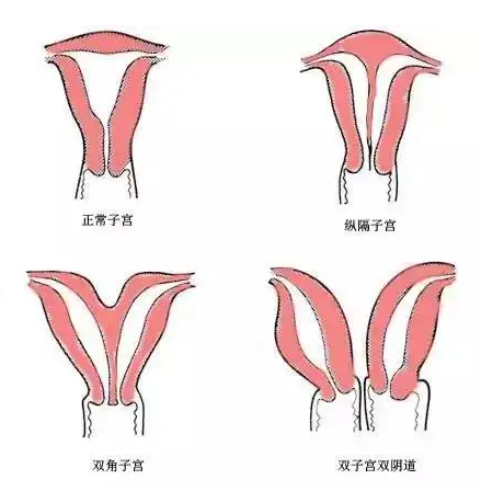 双角子宫试管怀孕如何保胎