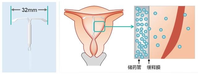 什么是曼月乐环？除了避孕效果还有哪些作用