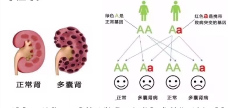 少弱畸形精子症患者遗传学筛查 常染色体显性多囊肾(ADPKD)