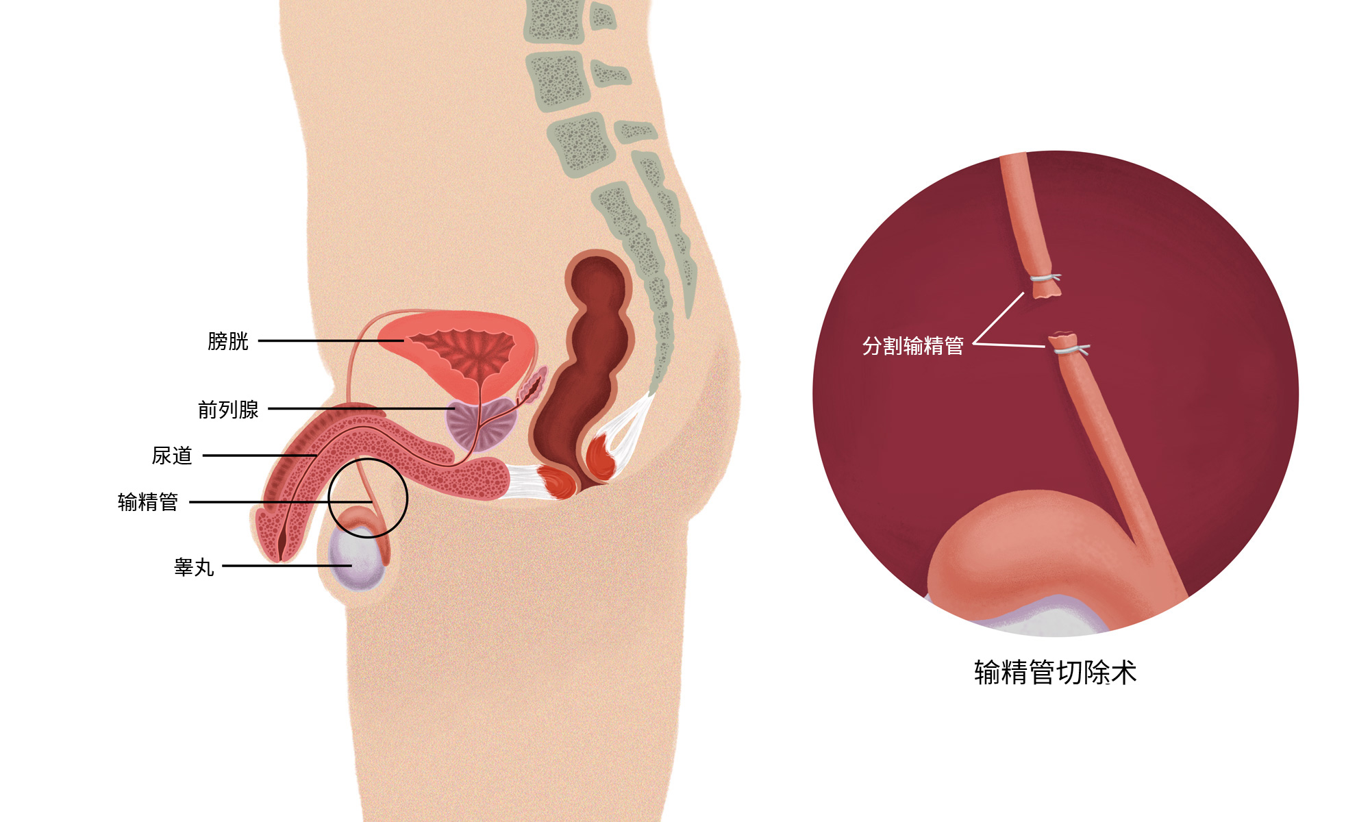 输精管疏通术多少钱 影响价格因素有那些