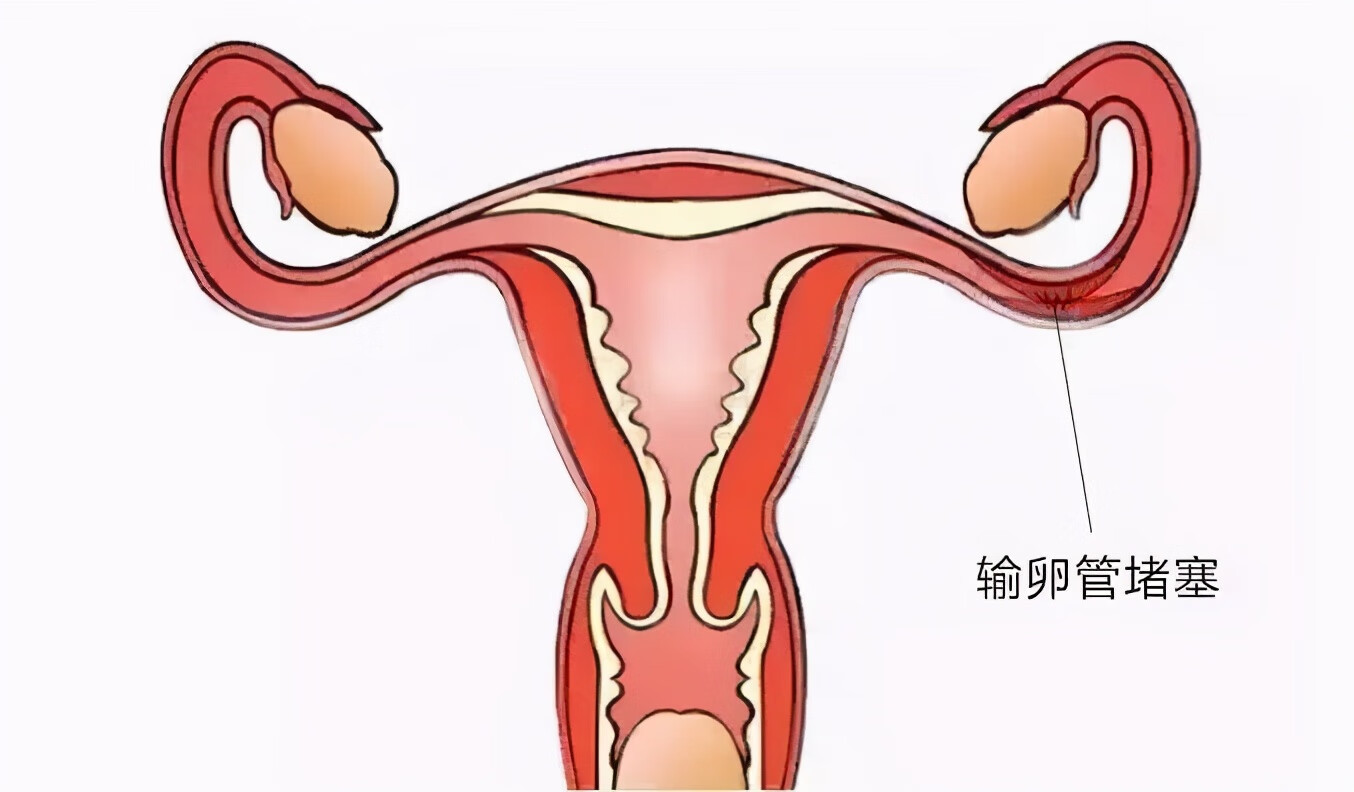 输卵管堵塞怎么治疗最好的方法