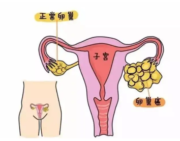 37岁患腺肌症怎么治疗 子宫腺肌症治疗医院